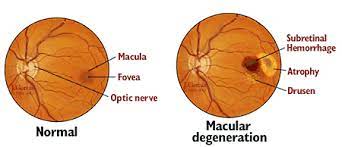 age-related-macular-degeneration