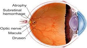 age-related-macular-degeneration