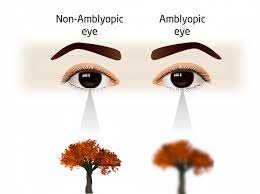 amblyopia