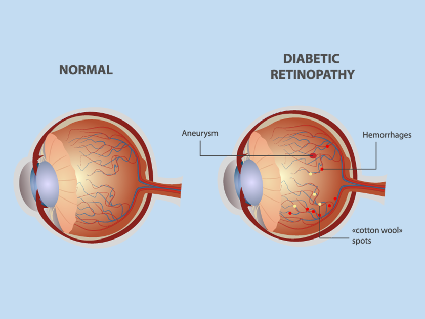 diabetic-retinopathy