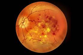 diabetic-retinopathy